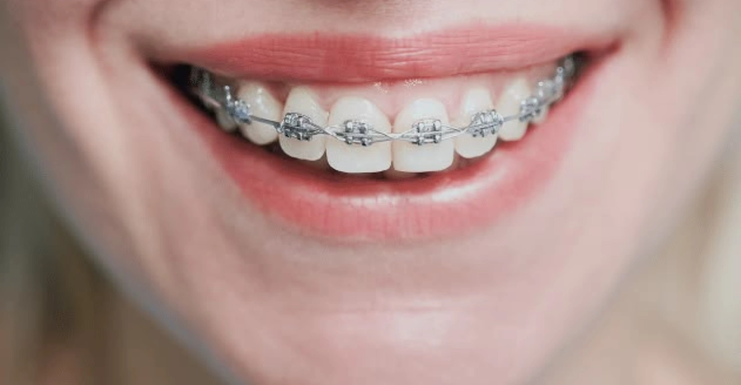 what are retractive orthodontics1